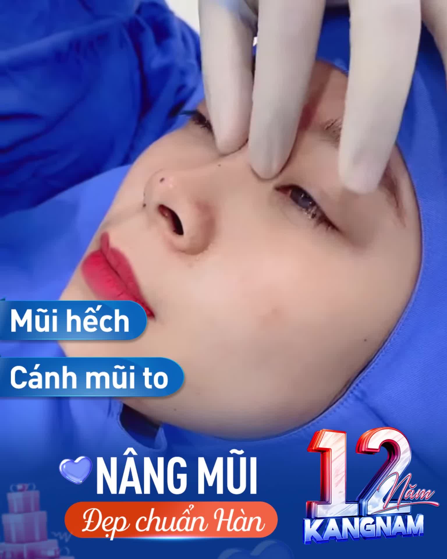 Mũi hếch, cánh mũi to - Bác sĩ  lên kế hoạch phẫu thuật cho khách hàng